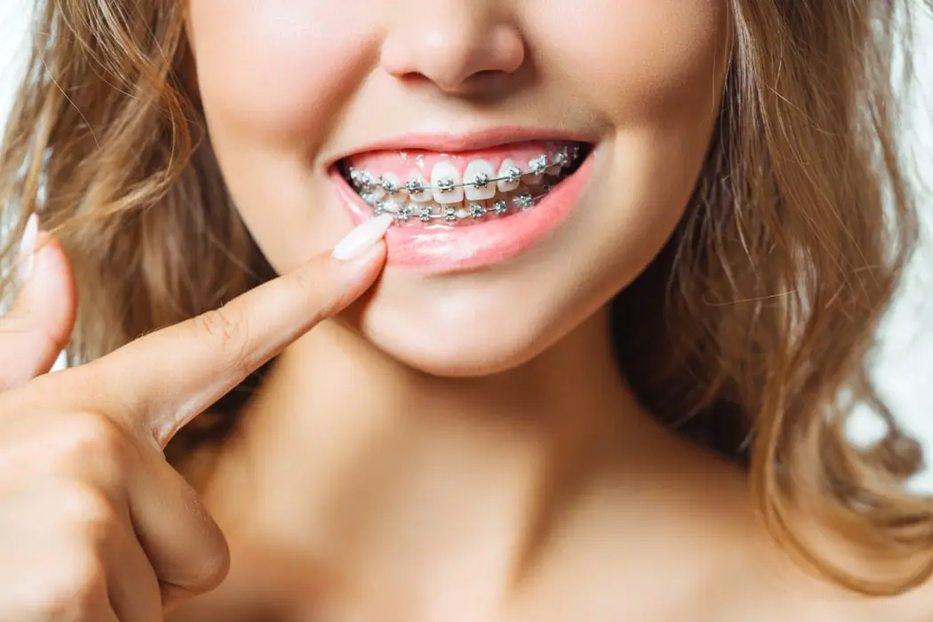 Aparat ortodontyczny — kiedy założyć, jakie warunki należy spełnić?
